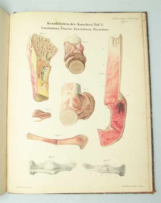 Atlas der Pathologischen Anatomie oder Bildliche Darstellung und Erläuterung der vorzüglichsten krankhaften Veränderungen der Organe und Gewebe des menschlichen Körpers. Zum Gebrauche für Aerzte und Studierende. Atlasband.